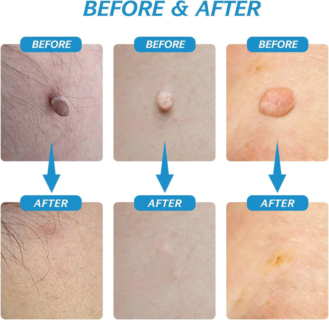 Skin Tag Remover